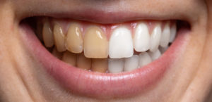 teeth whitening near me